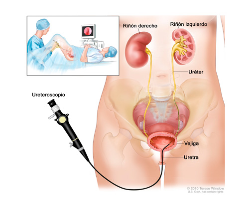 ureteroscopia flexible con laser