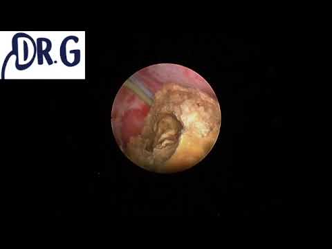 Tratamiento de piedras en el riñon con laser