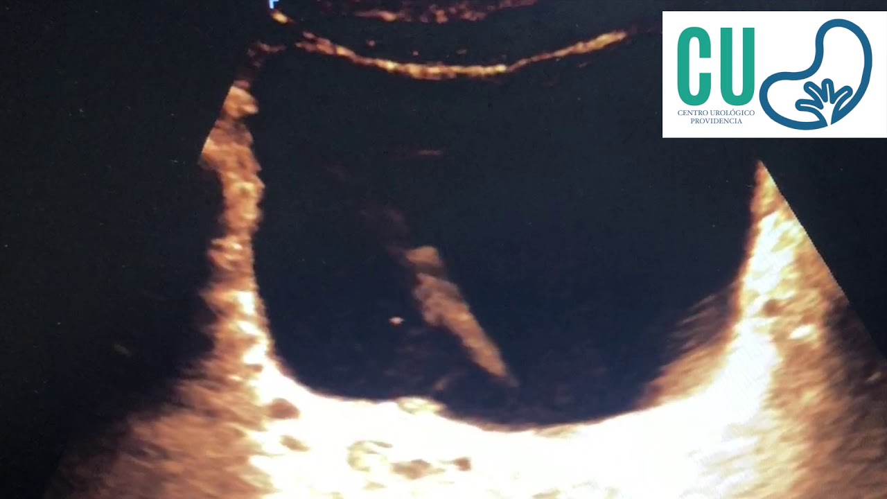 Jets Ureterales