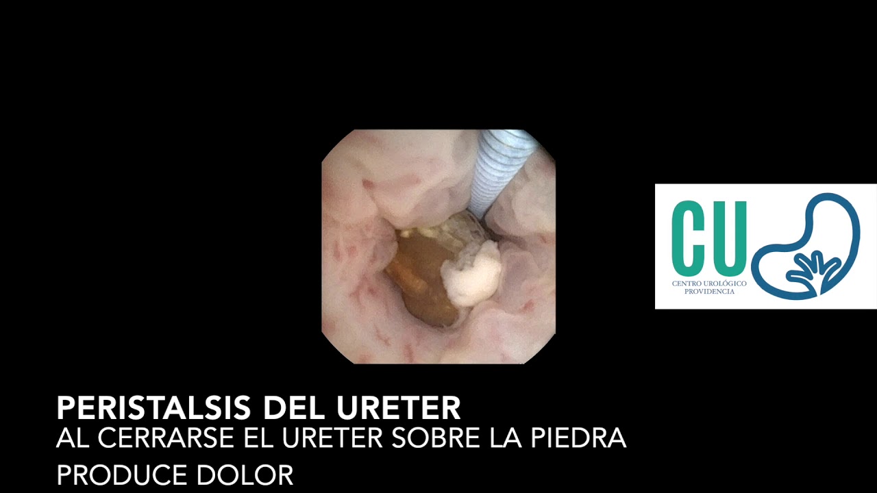 ¿Porque duelen las piedras en el riñón?