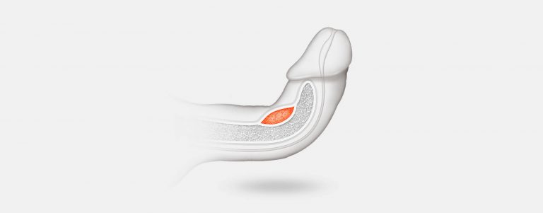 Enfermedad de Peyronie - Urólogo en Guadalajara Enfermedad de Peyronie