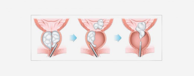 HOLEP (Enucleación prostática con láser de holmio) - Urólogo en Guadalajara HOLEP (Enucleación prostática con láser de holmio)